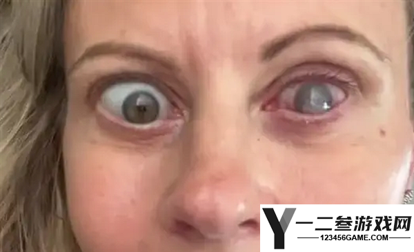 女子因忘摘隐形眼镜洗脸,导致一只眼被寄生虫咬出洞!