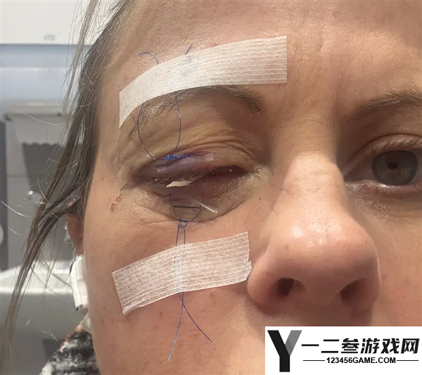 女子因忘摘隐形眼镜洗脸,导致一只眼被寄生虫咬出洞!